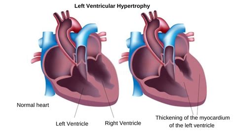 treatment for left ventricular hypertrophy